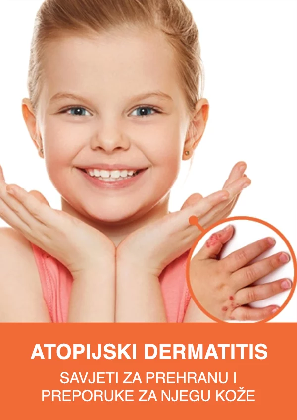 Atopijski dermatitis